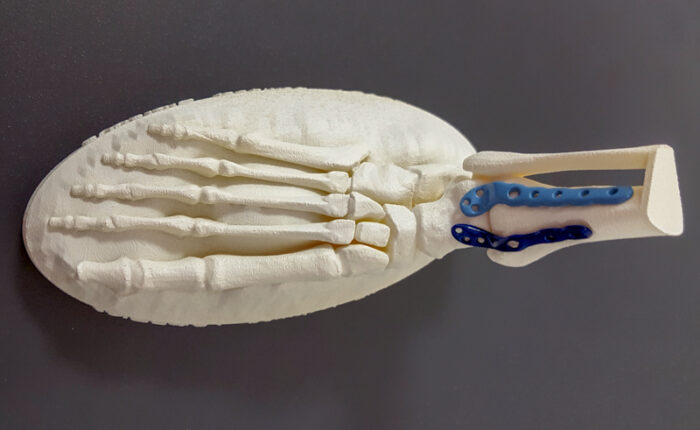 Prototype de prothèse de pied en impression 3d